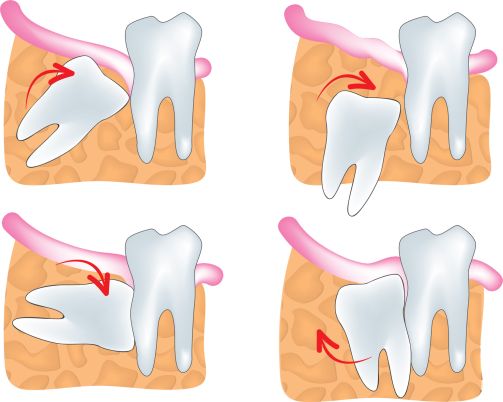 Wisdom Tooth Extraction